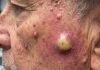 Big Cystic Blackheads Extraction