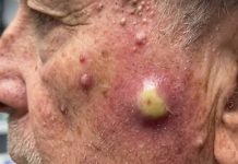 Big Cystic Blackheads Extraction