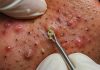 Blackheads Extraction Whiteheads Removal