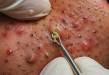 Blackheads Extraction Whiteheads Removal