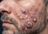Acne Blackheads Extraction Whiteheads