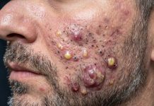 Acne Blackheads Extraction Whiteheads