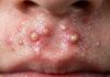 Blackheads Extraction Whiteheads