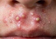 Blackheads Extraction Whiteheads