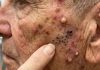 Acne Blackheads Extraction