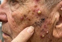 Acne Blackheads Extraction
