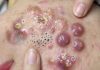 Big Cystic Acne Blackheads Extraction