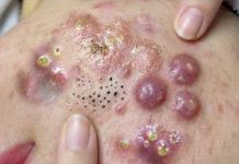 Big Cystic Acne Blackheads Extraction