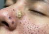 Cystic Blackheads Extraction
