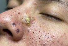 Cystic Blackheads Extraction