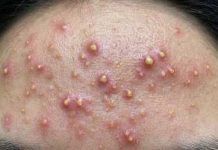 Blackheads Extraction Pimples