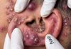 Blackheads Extraction Blackheads