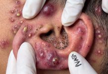 Blackheads Extraction Blackheads