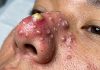 Cystic Blackheads Extraction Whiteheads