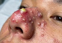 Cystic Blackheads Extraction Whiteheads