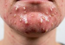 Blackheads Extraction