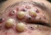 Big Cystic Blackheads Extraction Whiteheads
