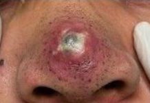 Big Cystic Blackheads Extraction
