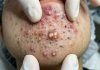 Blackheads Extraction Whiteheads