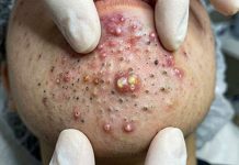 Blackheads Extraction Whiteheads