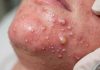 Cystic Blackheads Extraction