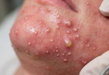 Cystic Blackheads Extraction