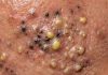 Blackheads Extraction Whiteheads