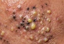 Blackheads Extraction Whiteheads
