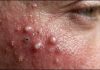 Blackheads Extraction Whiteheads