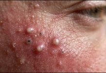 Blackheads Extraction Whiteheads
