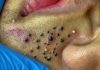 Blackheads Extraction Blackheads