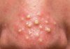 Cystic Blackheads Extraction