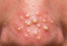 Cystic Blackheads Extraction