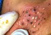 Acne Blackheads Extraction Whiteheads