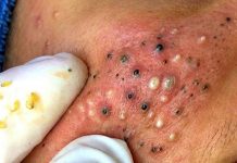 Acne Blackheads Extraction Whiteheads
