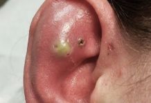 Big Blackheads Extraction