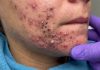 Acne Blackheads Extraction