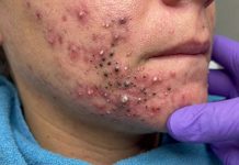 Acne Blackheads Extraction