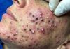 Acne Blackheads Extraction Whiteheads