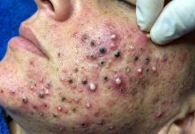Acne Blackheads Extraction Whiteheads