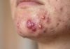 Blackheads Extraction