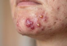 Blackheads Extraction