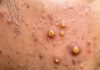 Cystic Blackheads Extraction