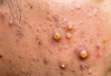 Cystic Blackheads Extraction
