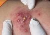 Blackheads Extraction