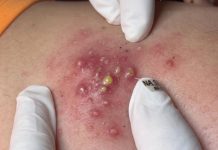 Blackheads Extraction
