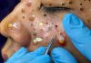 Blackheads Extraction Removal