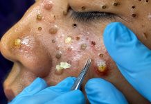 Blackheads Extraction Removal
