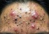 Blackheads Extraction