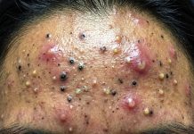 Blackheads Extraction